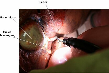 Abb. 3: Cholezystektomie via NOTES am Leber-Galle-Modell